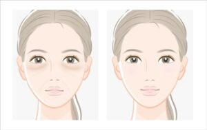 目の下のクマとほうれい線が改善された女性の顔