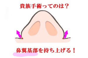 『貴族手術をすると、小鼻が広がります。その防止手術を同時に行うことで、悩みはなくなります。』の画像