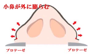 『貴族手術をすると、小鼻が広がります。その防止手術を同時に行うことで、悩みはなくなります。』の画像