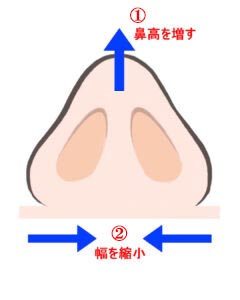 『貴族手術をすると、小鼻が広がります。その防止手術を同時に行うことで、悩みはなくなります。』の画像