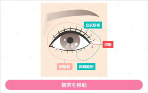 目尻靱帯切断、靱帯移動範囲のイラスト
