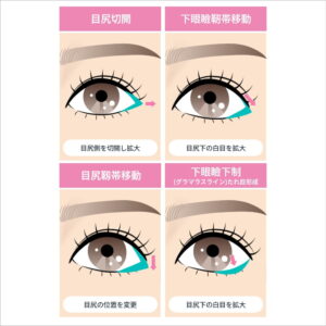 目尻切開・グラマラスライン形成との違いを解説する図