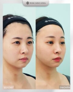 尻切開＋自然癒着6点のビフォーアフター（バストアップ）