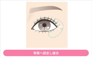 靭帯を骨膜に固定し縫合するイラスト