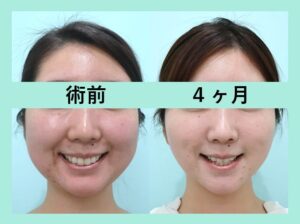 脂肪吸引と糸リフトの他院修正のビフォーアフター(正面)