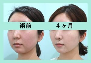 脂肪吸引と糸リフトの他院修正のビフォーアフター(横)