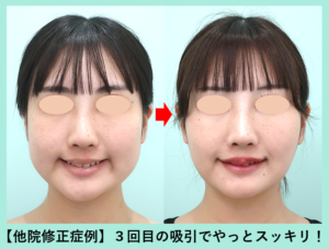 脂肪吸引他院修正のビフォーアフター