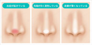 鼻炎症状と白変色皮膚の比較