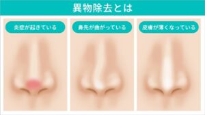 鼻の炎症、曲がり、皮膚が薄い状態のイラスト