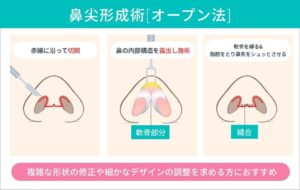 鼻尖形成術オープン法の施術ステップ