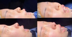 オステオポール除去と鼻修正手術のビフォーアフター(横顔)