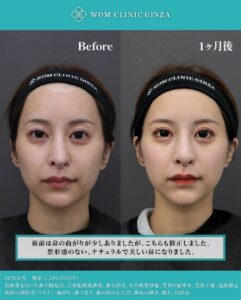 尖りすぎた鼻の修正のビフォーアフター(正面)