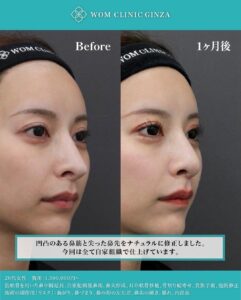 尖りすぎた鼻の修正のビフォーアフター(横顔)