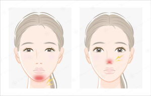施術部位(鼻・顎先)に赤みが生じているイラスト