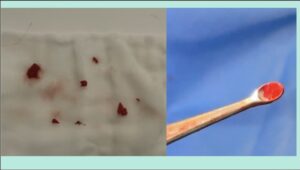 除去したアクアミドの写真