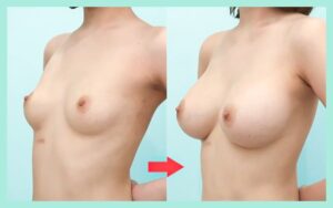 シリコンバッグ豊胸の術後比較