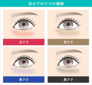 目の下のクマの種類と特徴を比較したイラスト