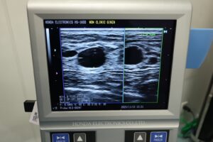 超音波診断装置の画面に映る複数のリンパ節