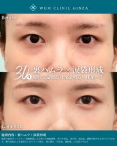 30代女性の目の下のたるみ取り前後の比較