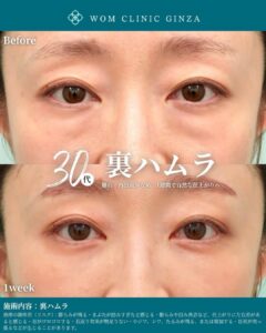 裏ハムラ施術前後の女性の目元比較