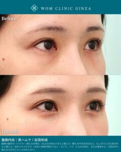 施術前後比較女性の目のアップ
