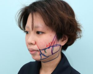 『脱丸顔へ『下顔面』をスッキリさせるフルコース』の画像