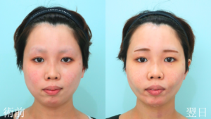 『脱丸顔へ『下顔面』をスッキリさせるフルコース』の画像