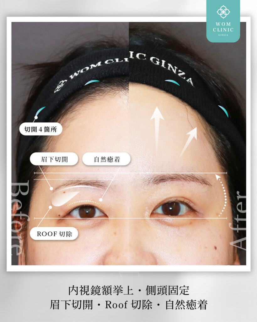 『【施術の組み合わせは、アップセルではない!】全体バランスを整える究極の目元整形』の画像