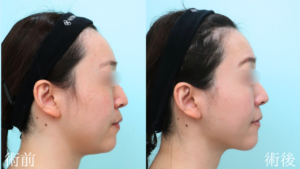 『輪郭施術で垢抜けを。本来の美しさを引き出す『顔の脂肪吸引』。』の画像