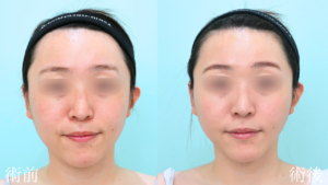 『輪郭施術で垢抜けを。本来の美しさを引き出す『顔の脂肪吸引』。』の画像