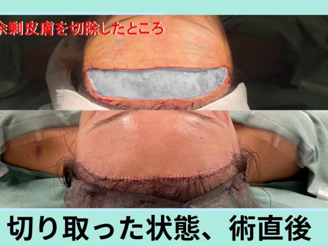 前額リフト：術中、術後の写真