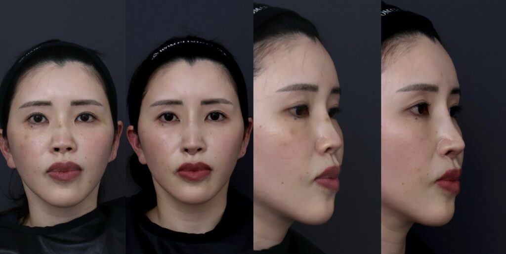『【重度鼻修正】肋軟骨手術後の鼻の穴の見えすぎを改善 自家組織で鼻の構造を再建した修正鼻整形』の画像