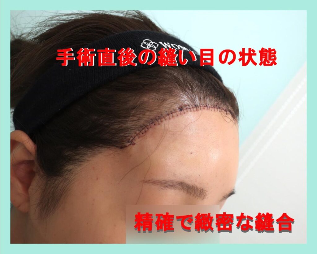 前額リフト術後1M写真