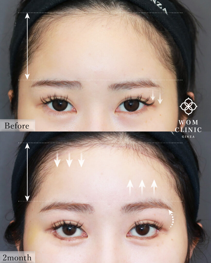 『【最新技術の融合】「おでこを広くしたくない」方へ。内視鏡額挙上・額縮小術を解説』の画像