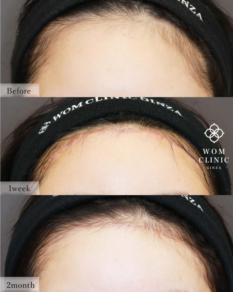 『【最新技術の融合】「おでこを広くしたくない」方へ。内視鏡額挙上・額縮小術を解説』の画像