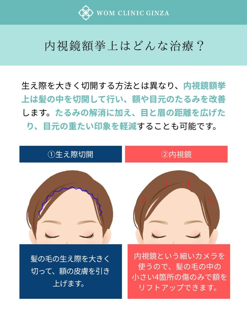 『【SNSで大バズり!】内視鏡額挙上だからできる変化。二重整形では届かない「優しさ」を。』の画像