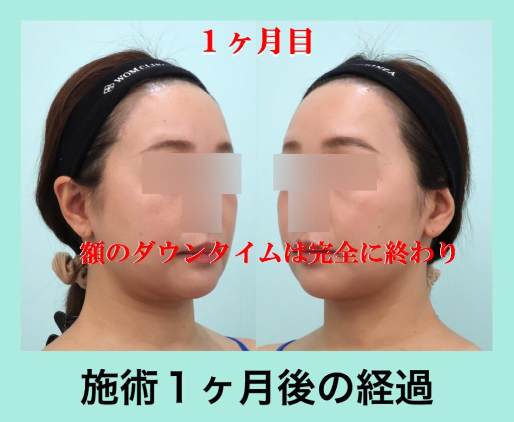 前額リフト術後１M