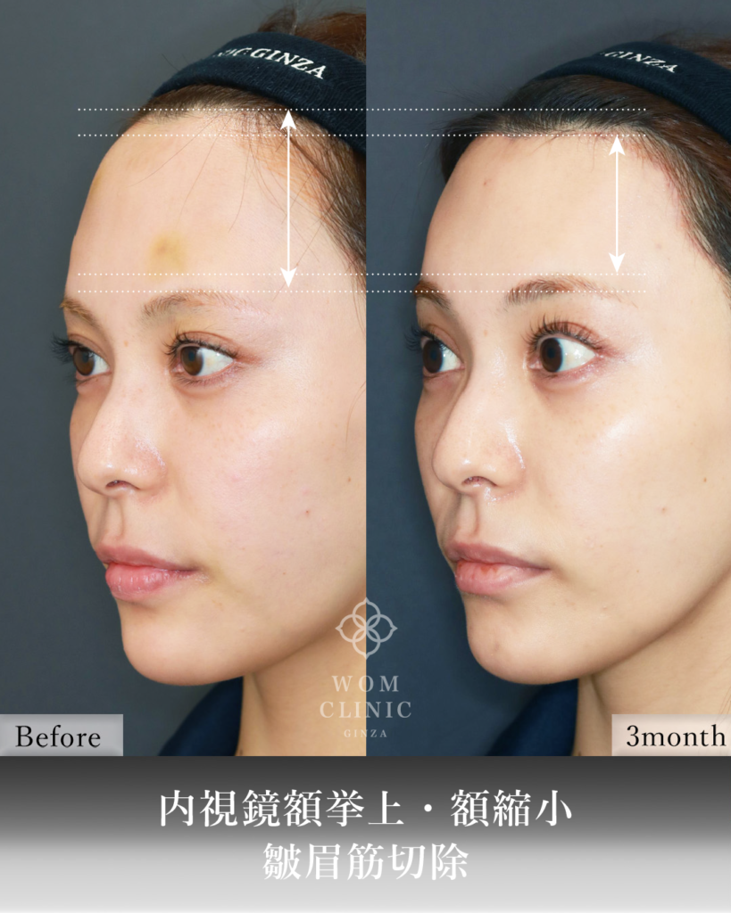 『広い額を狭く、重い目元を明るく。内視鏡額挙上×額縮小の相乗効果』の画像