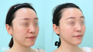 『輪郭施術で垢抜けを。本来の美しさを引き出す『顔の脂肪吸引』。』の画像