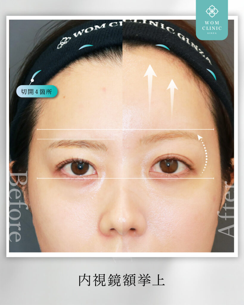 『【症例解説】内視鏡額挙上で優しい目元へ。驚いた目にならないプロの技術』の画像