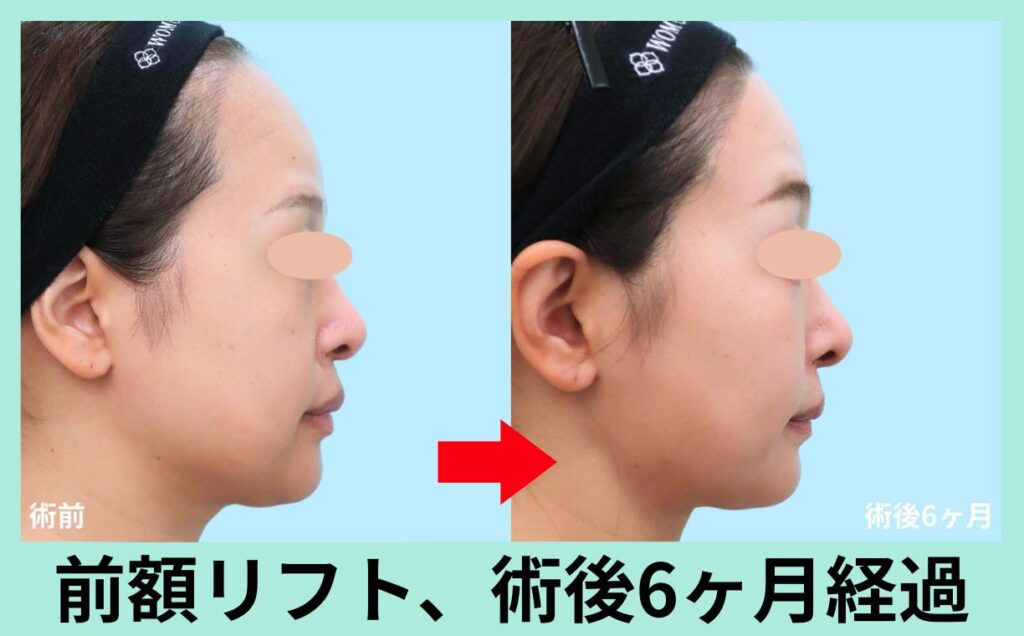 前額リフト術後写真