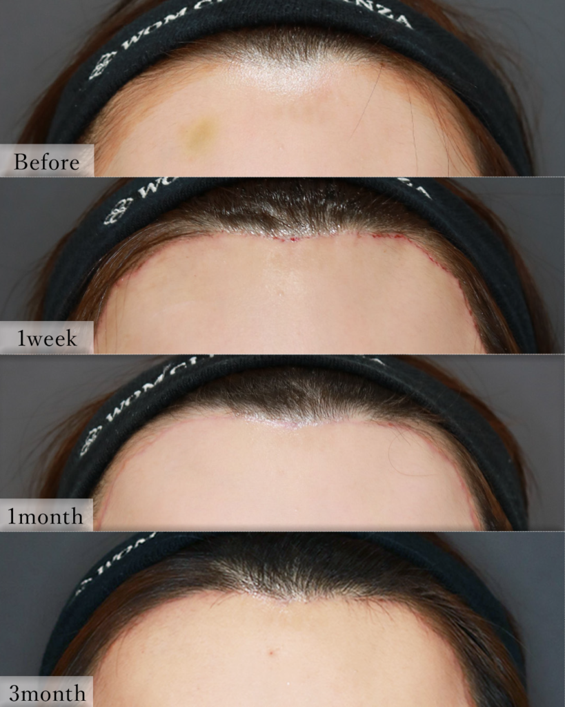 『広い額を狭く、重い目元を明るく。内視鏡額挙上×額縮小の相乗効果』の画像