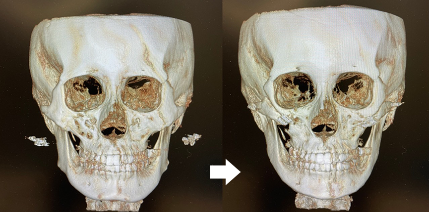『自然に整える輪郭形成 輪郭3点骨切り×脂肪吸引』の画像