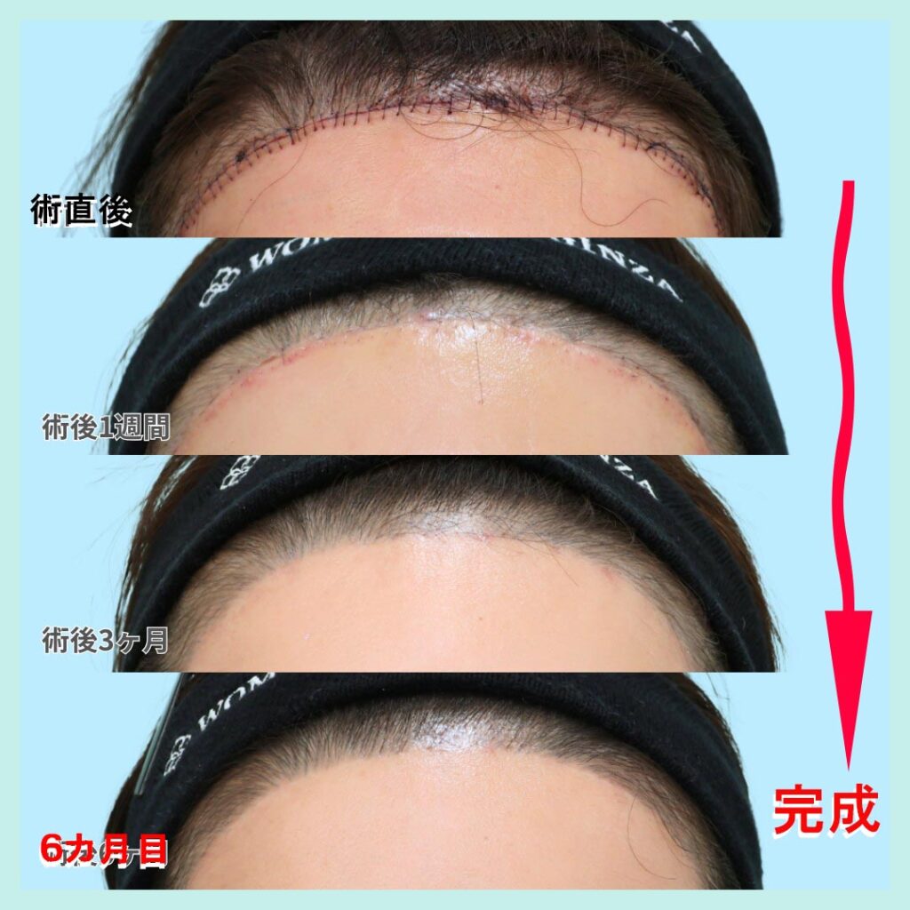 前額リフト術後写真：傷跡 
