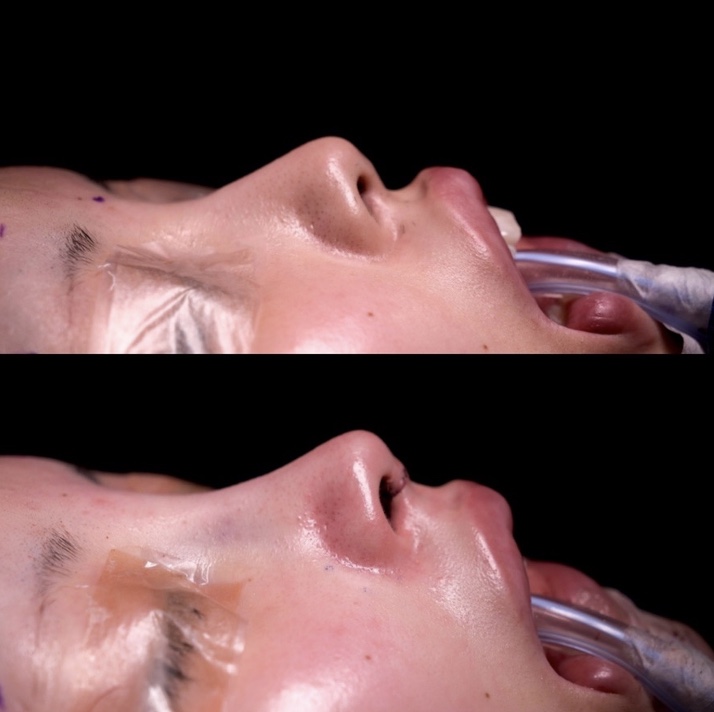 『【鼻の長さで顔の印象は変わる】 可愛いから綺麗へ ― 鼻の長さをデザインする鼻整形』の画像