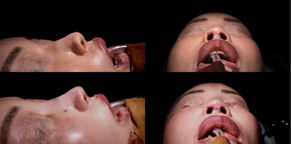 『【重度鼻修正】肋軟骨手術後の鼻の穴の見えすぎを改善 自家組織で鼻の構造を再建した修正鼻整形』の画像