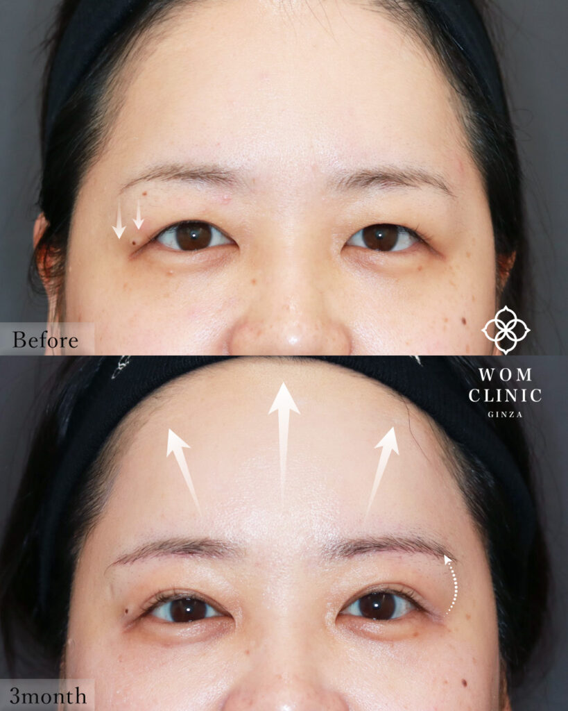 『【施術の組み合わせは、アップセルではない!】全体バランスを整える究極の目元整形』の画像