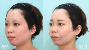 『脱丸顔へ『下顔面』をスッキリさせるフルコース』の画像