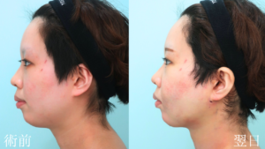 『脱丸顔へ『下顔面』をスッキリさせるフルコース』の画像