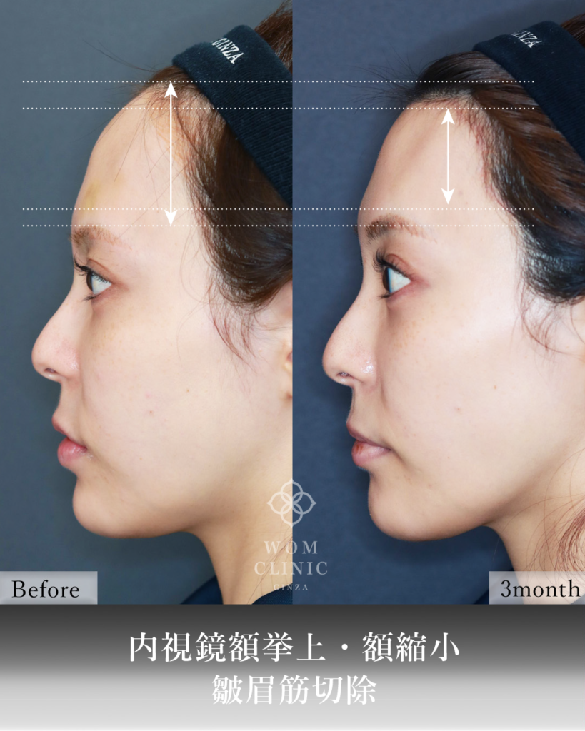 『広い額を狭く、重い目元を明るく。内視鏡額挙上×額縮小の相乗効果』の画像